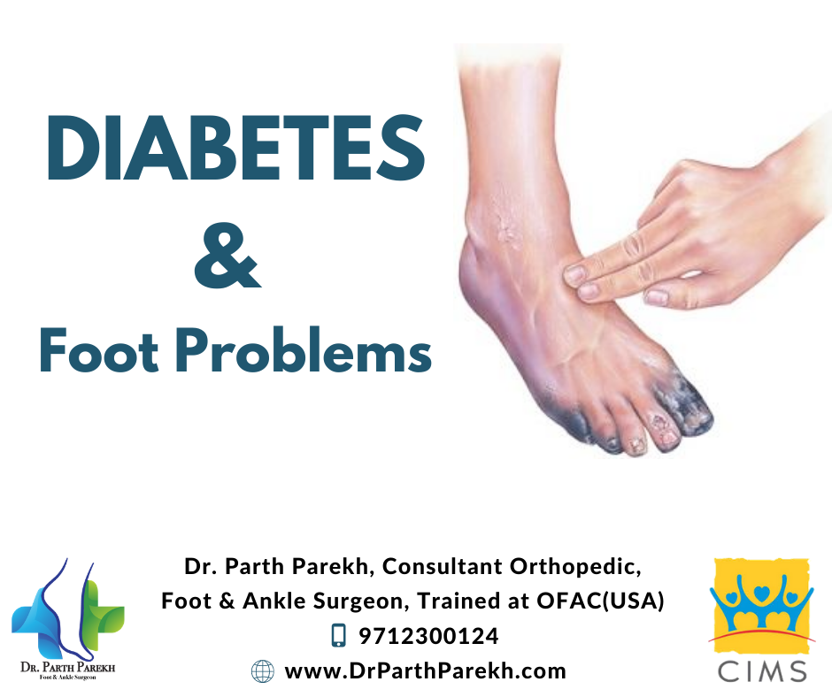 Diabetes And Foot Problems Dr Parth Parekh
