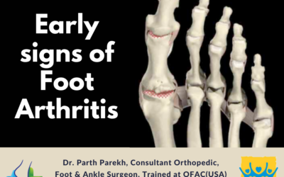 Early signs of Foot Arthritis