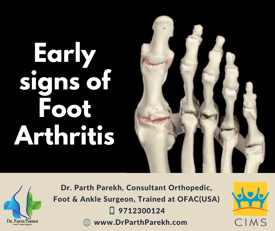 Early signs of Foot Arthritis Dr. Parth Parekh